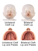 Unilateral_and_Bilateral_Cleft_Lip_and_Palate